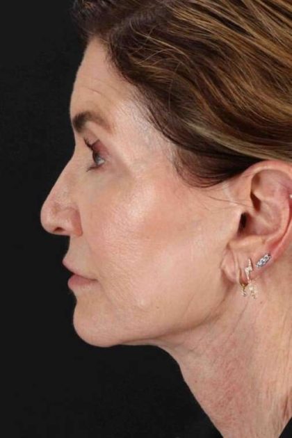 Facelift Before & After Patient #1789