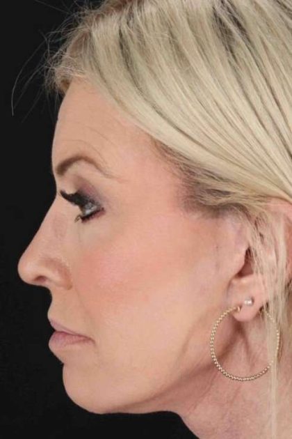 Browlift Before & After Patient #1209
