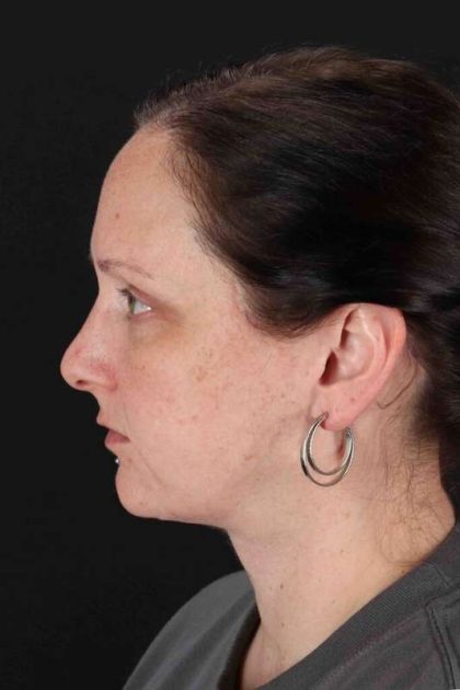 Facelift Before & After Patient #1843