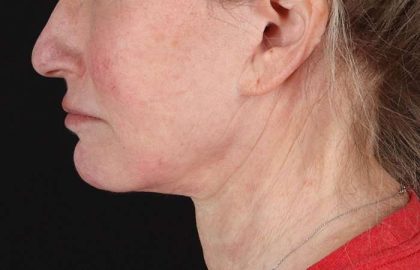 Facelift Before & After Patient #1866