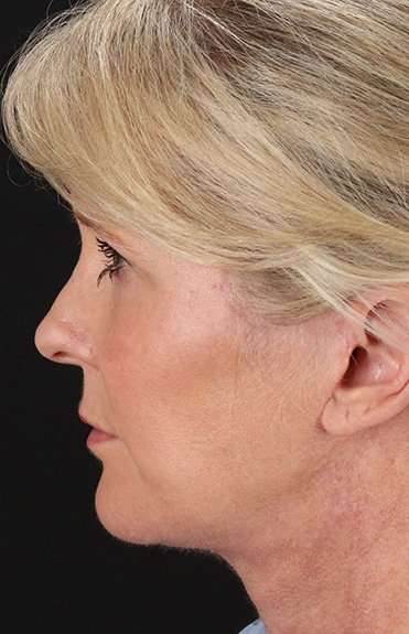 Facelift Before & After Patient #1877
