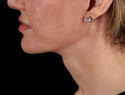 Facelift Before & After Patient #1921