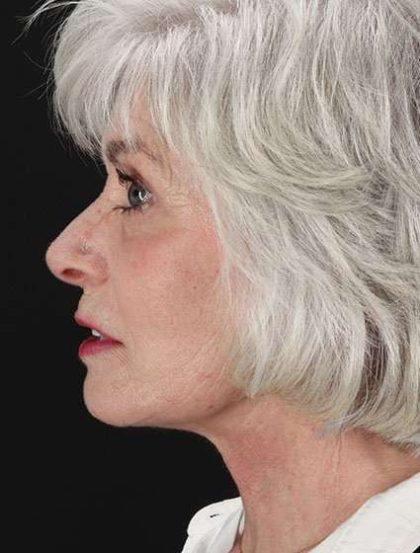 Facelift Before & After Patient #1932