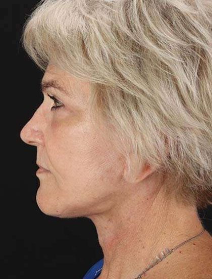 Facelift Before & After Patient #1943