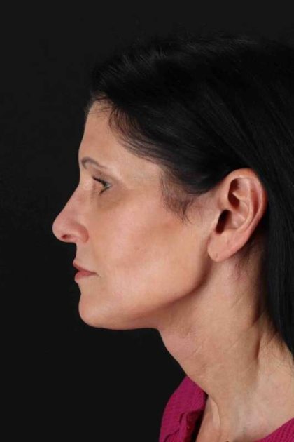 Fat Grafting To The Face Before & After Patient #2005