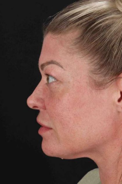 Fat Grafting To The Face Before & After Patient #2016