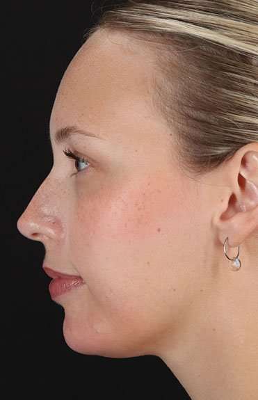 Fillers Before & After Patient #2030