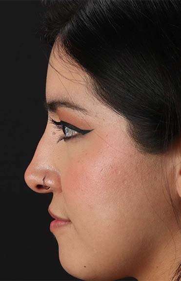 Fillers Before & After Patient #2041