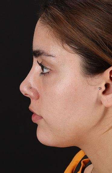 Fillers Before & After Patient #2052