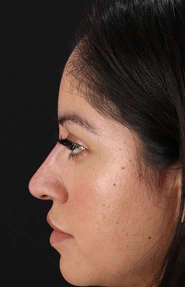Fillers Before & After Patient #2063