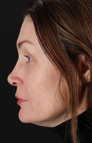 Lip Lift Before & After Patient #2144