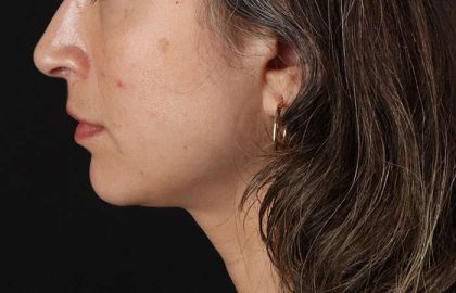 Lip Lift Before & After Patient #2166