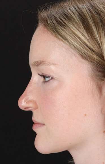Liquid Rhinoplasty Before & After Patient #2177