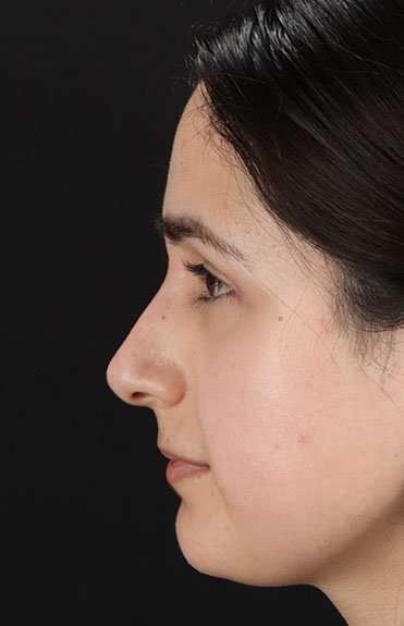 Liquid Rhinoplasty Before & After Patient #2188