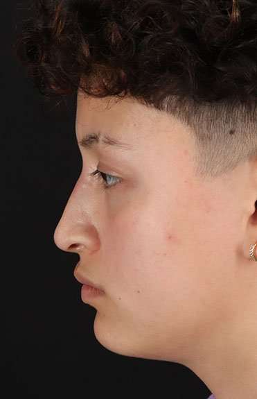 Liquid Rhinoplasty Before & After Patient #2199