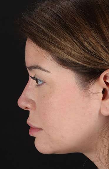 Liquid Rhinoplasty Before & After Patient #2210