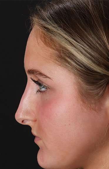 Liquid Rhinoplasty Before & After Patient #2221