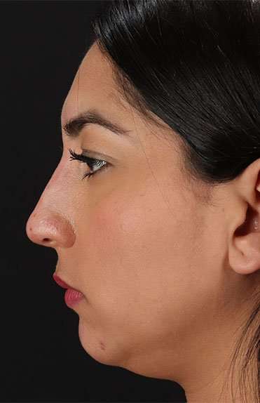 Liquid Rhinoplasty Before & After Patient #2232