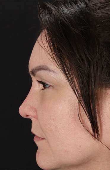 Liquid Rhinoplasty Before & After Patient #2243