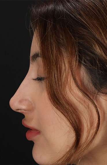Liquid Rhinoplasty Before & After Patient #2254