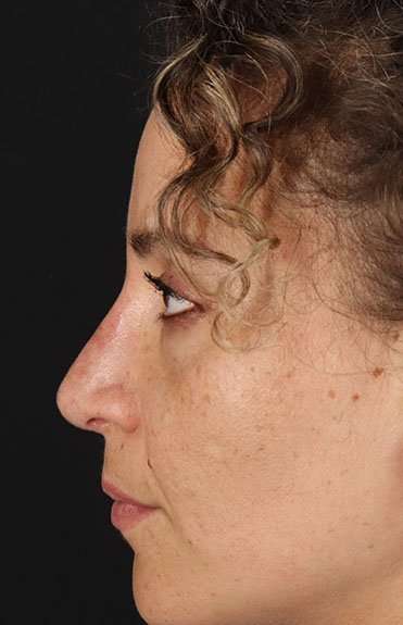 Liquid Rhinoplasty Before & After Patient #2276