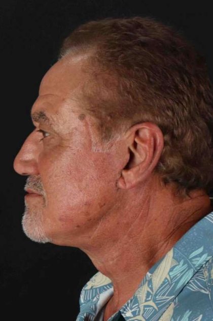Lower Blepharoplasty Before & After Patient #2310