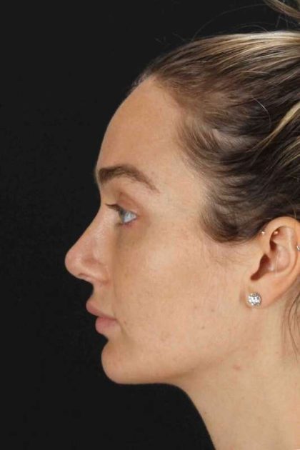 Browlift Before & After Patient #1297