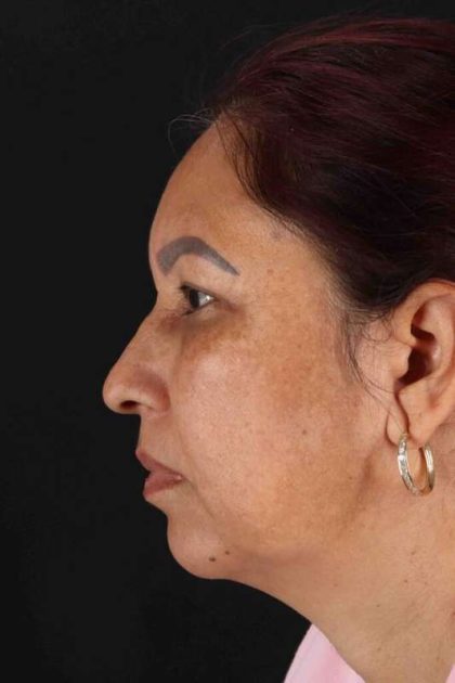 Lower Blepharoplasty Before & After Patient #2321