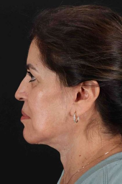 Lower Blepharoplasty Before & After Patient #2343