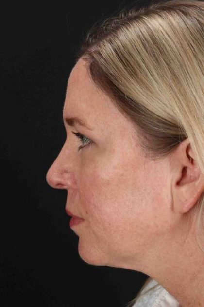 Lower Blepharoplasty Before & After Patient #2376