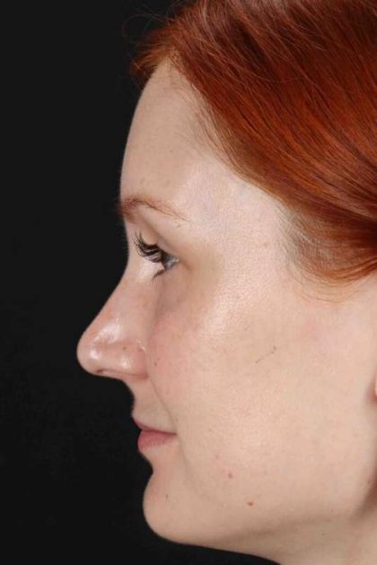 Lower Blepharoplasty Before & After Patient #2409