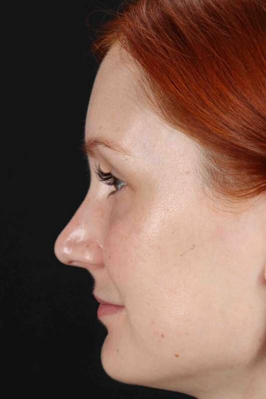 Lower Blepharoplasty Before & After Patient #2409