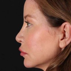 Browlift Before & After Patient #1308