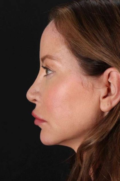 Browlift Before & After Patient #1308