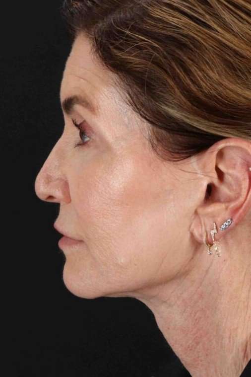 Neck Lift Before & After Patient #2452