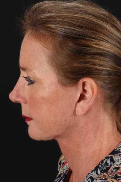 Neck Lift Before & After Patient #2494