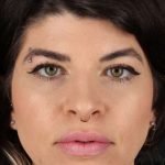 Browlift Before & After Patient #1220
