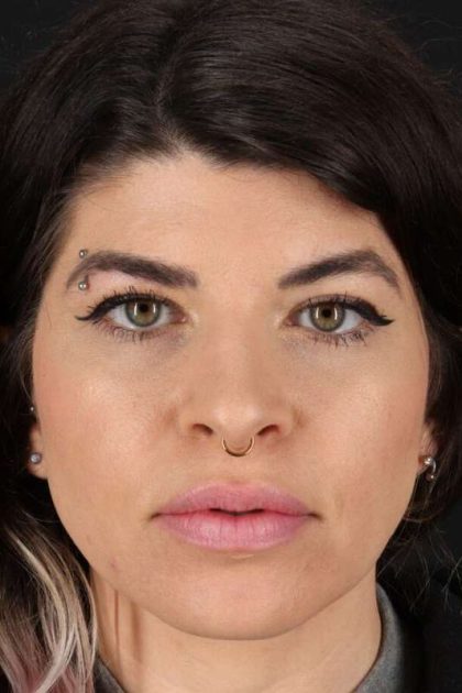 Browlift Before & After Patient #1220