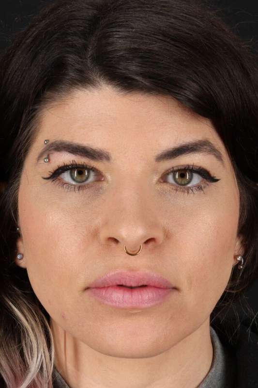 Browlift Before & After Patient #1220