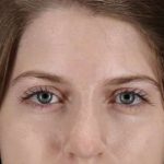 Browlift Before & After Patient #1319