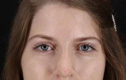 Browlift Before & After Patient #1319