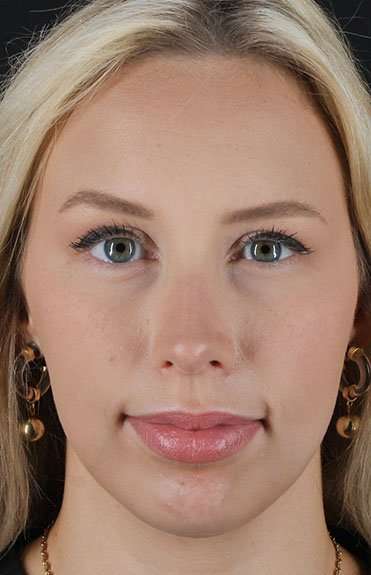 Fillers Before & After Patient #2030