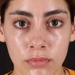 Fillers Before & After Patient #2052