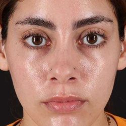 Fillers Before & After Patient #2052