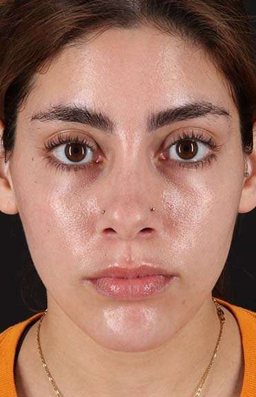 Fillers Before & After Patient #2052