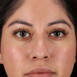 Fillers Before & After Patient #2063