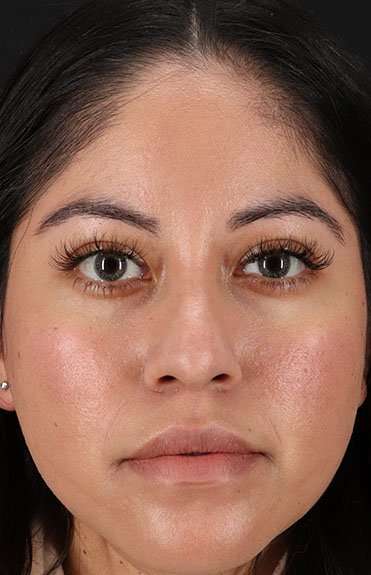 Fillers Before & After Patient #2063