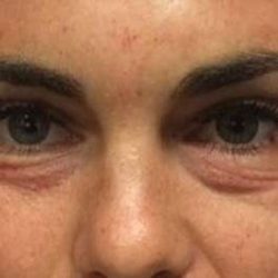 Fillers Before & After Patient #2066