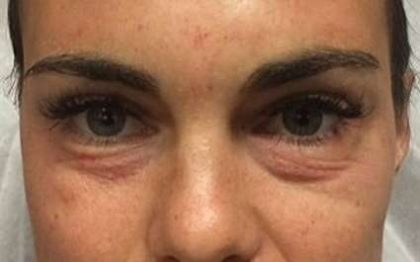 Fillers Before & After Patient #2066