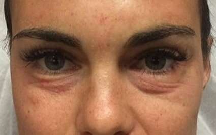 Fillers Before & After Patient #2066